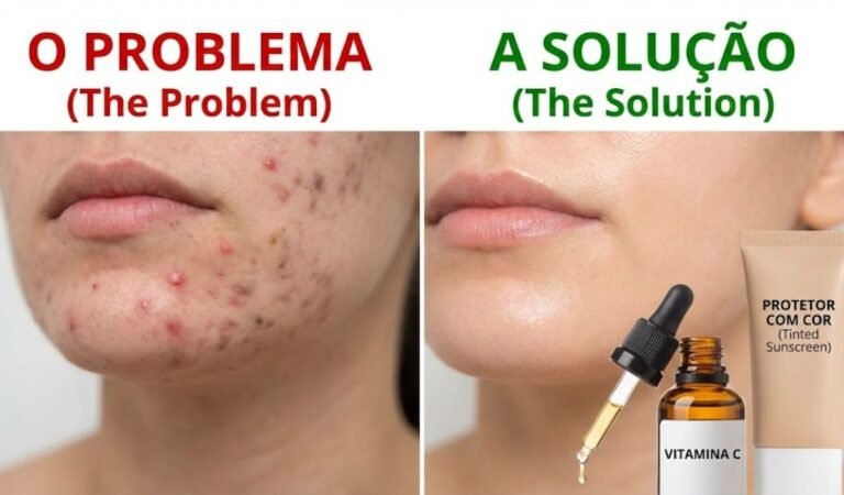 Como tratar acne e manchas ao mesmo tempo